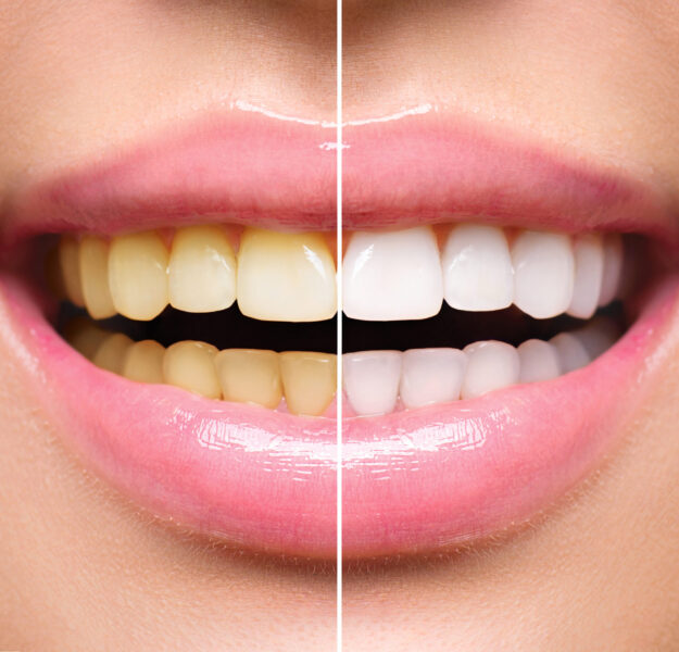Teeth Whitening Course